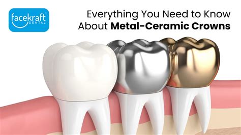 metal ceramic crown construction